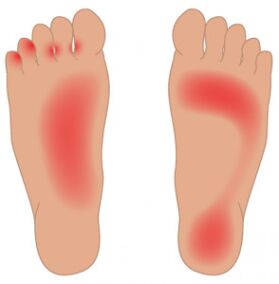 A propagação do fungo ao longo da superfície dos pés