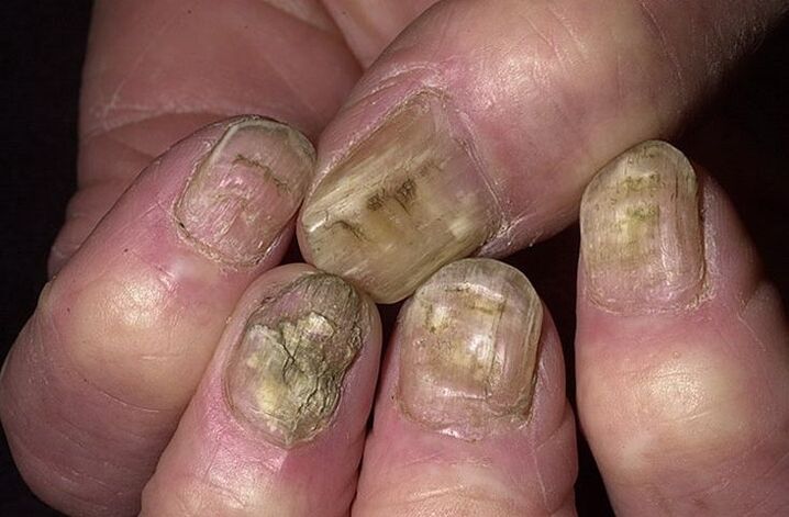 Deformação, separação e desintegração das unhas devido a fungos