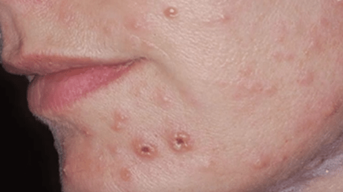 Infecção fúngica da pele do rosto