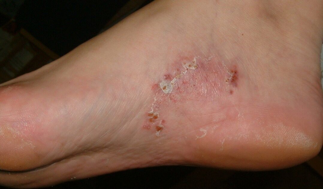 Manifestações de uma infecção fúngica no pé