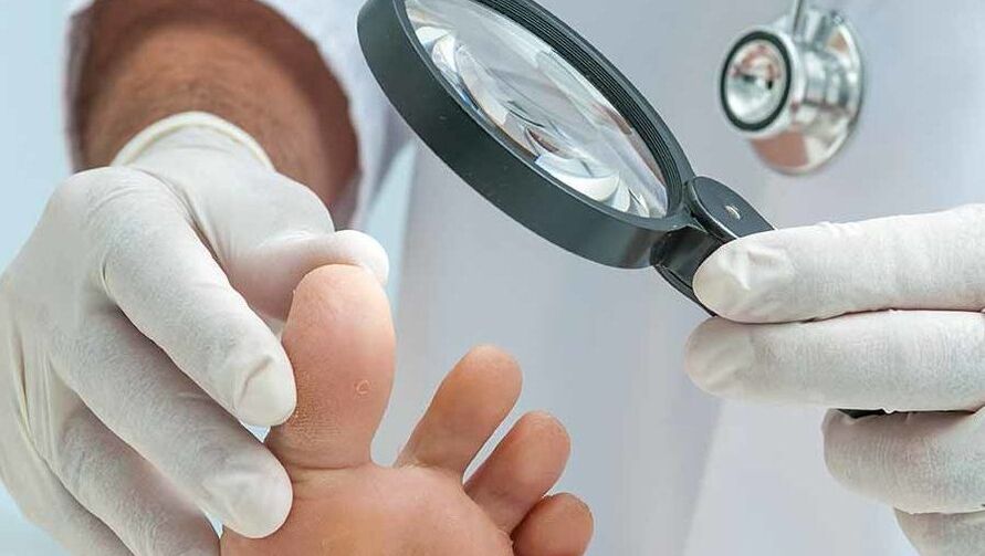 O diagnóstico de fungo nas unhas é feito por um dermatologista